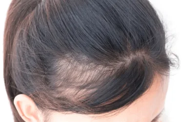 Frontale Fibroserende Alopecia (FFA): Begrijpen, Aanpakken en Ondersteunen