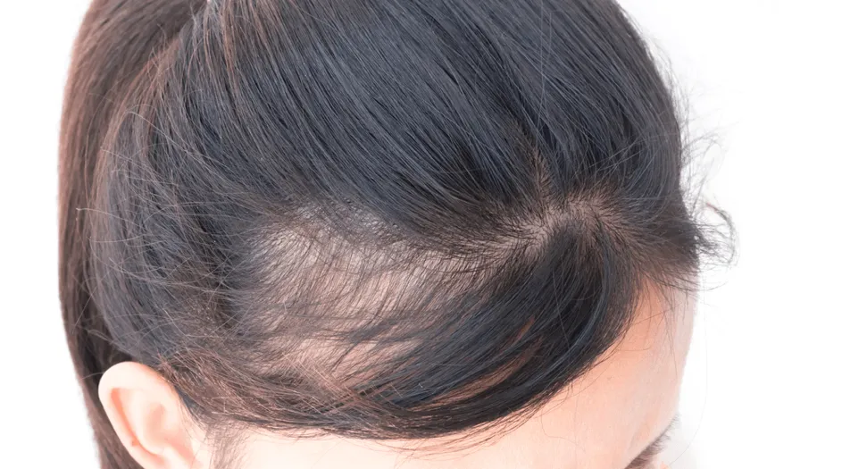Frontale Fibroserende Alopecia (FFA): Begrijpen, Aanpakken en Ondersteunen